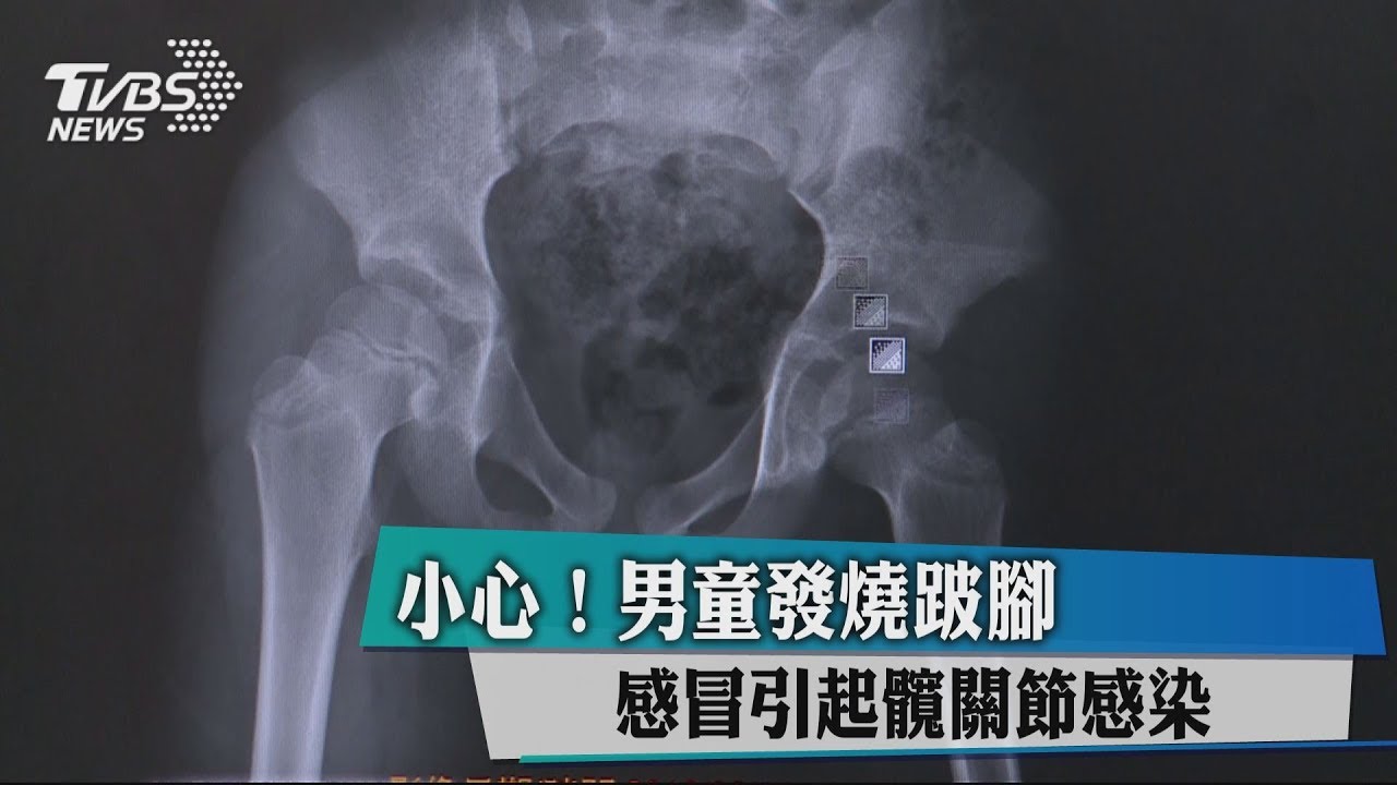 小心!男童發燒跛腳 感冒引起髖關節感染