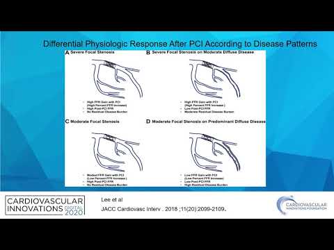 Physiology post PCI: The new gold standard?_Hakeem_Coronary on Demand