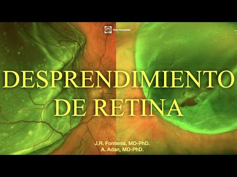Desprendimiento de Retina.