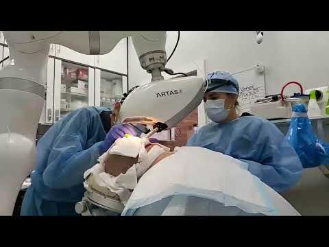 Live Harvesting IX Artas Robotic Hair Transplant / Maxim Medical, Robotic Hair Transplant Clinic