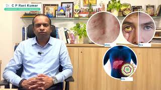 ಕಾರ್ಬಮಜೆಪೈನ್ ಸರಳ ವಿವರಣೆ | ಬಳಕೆ, ದೋಷಗಳು, ಗರ್ಭಧಾರಣೆ #epilepsyawareness #ಕಾರ್ಬಮಜೆಪೈನ್