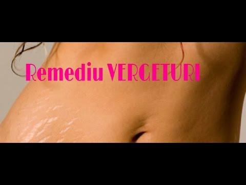 mărirea penisului cu vergeturi exerciții de erecție kegel