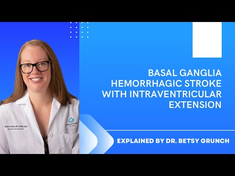 Case study 49 - Basal Ganglia Hemorrhagic Stroke with Intraventricular Extension