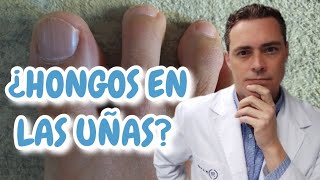 ¿Hongos en las uñas Dermatólogo explica todo lo que debes saber sobre la onicomicosis