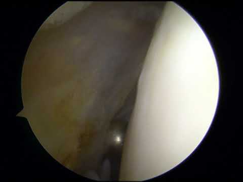 Che per alleviare il dolore in coxartrosi dellanca Contorta colonna vertebrale cervicale