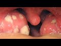 tonsil stones removal throat, how remove tonsil stones,tonsil