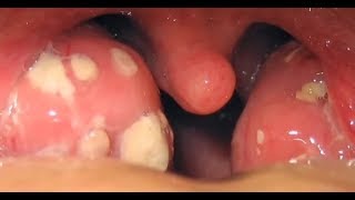 tonsil stones removal throat, how remove tonsil stones,tonsil