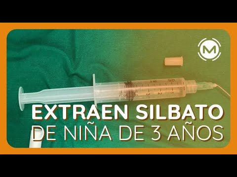 Extraen silbato de los bronquios de una niña de tres años
