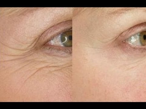 Smooth Eye Wrinkles With This Easy 5 Minute Face Massage Video