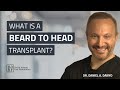 What Is A Beard To Head Transplant