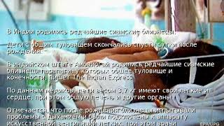 В Индии родились редчайшие сиамские близнецы