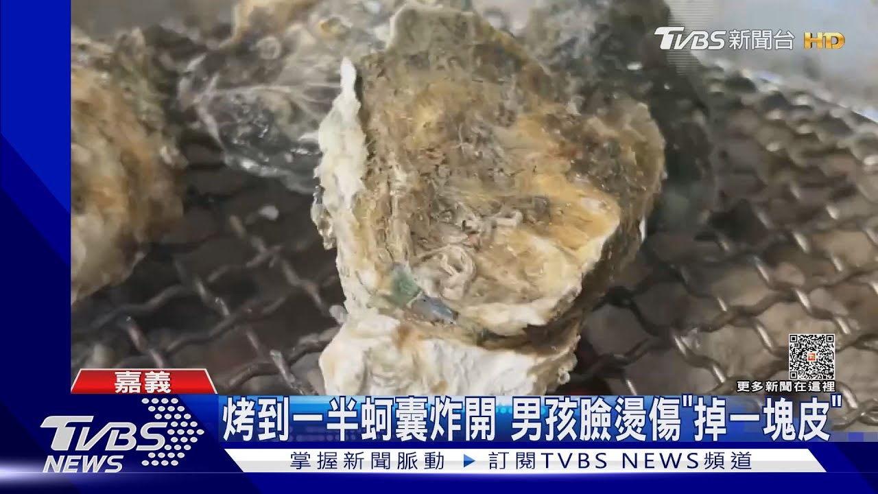 心疼!東石烤蚵男童炸傷臉「掉一塊皮」 業者:很抱歉
