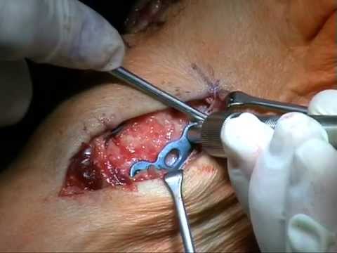 Norme per la fornitura di cure mediche specialistiche in caso di osteocondrosi Sposta il ginocchio