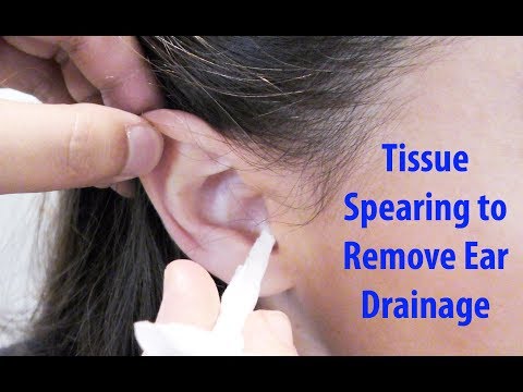 Tissue Spears to Remove Ear Drainage