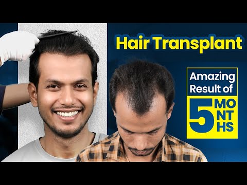 Hairline & Temple Transformation
