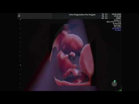 Ultrassom 4D em feto de 11 semanas