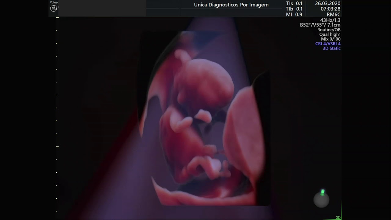 Ultrassom 4D em feto de 11 semanas