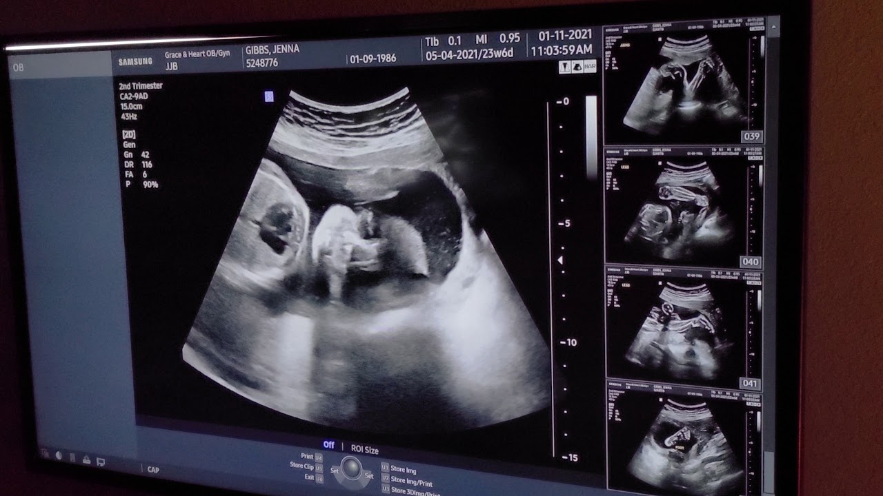 Ultrasound At 24 Weeks Wallpaper Site