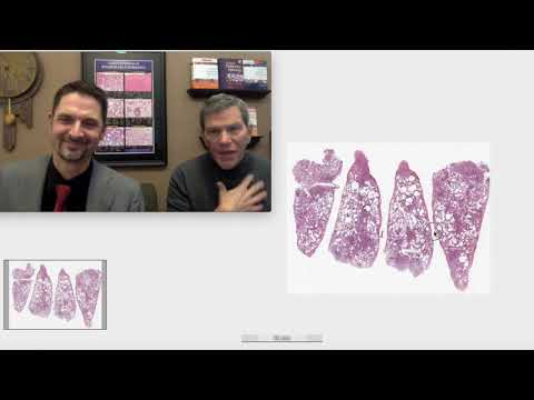 Pattern 3 - Cellular Infiltrates, CTD-Associated ILD (Top 25 Pearls Series, Topic 4, Pearl 1)