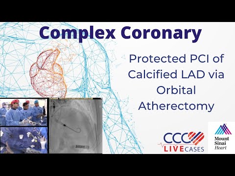 Protected PCI of Calcified LAD via Orbital Atherectomy - June 18, 2019