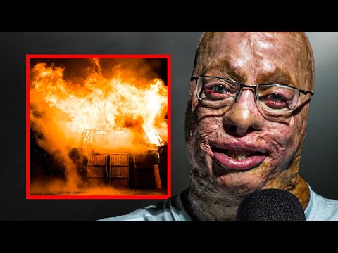 How This Severe Burn Survivor Overcame a 5% Chance to Live