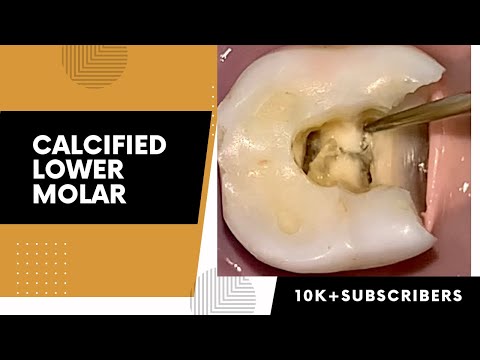 Decayed and Calcified Mandibular Molar Access Opening