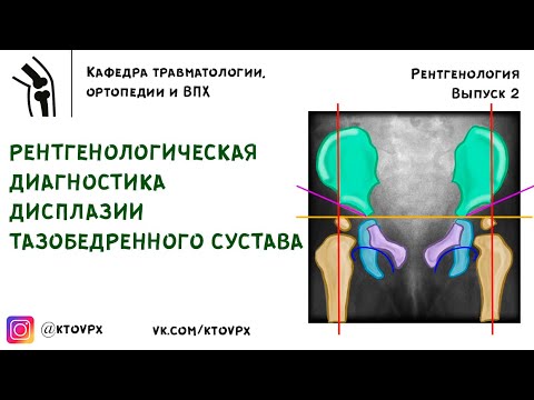 Рентгенологическая диагностика дисплазии тазобедренного сустава | Травматология и ортопедия