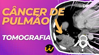 CÂNCER de PULMÃO - Neoplasia Pulmonar na TC de Tórax