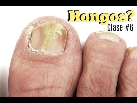 Los preparados interiores al hongo de las uñas El ajenjo del hongo en los pies las revocaciones