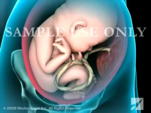 Breech Birth Position - 3D Rotation