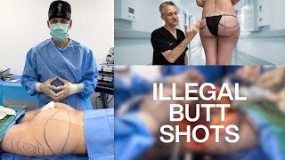 Surgical Removal of Silicone Buttock Injections (EXTREMELY GRAPHIC)