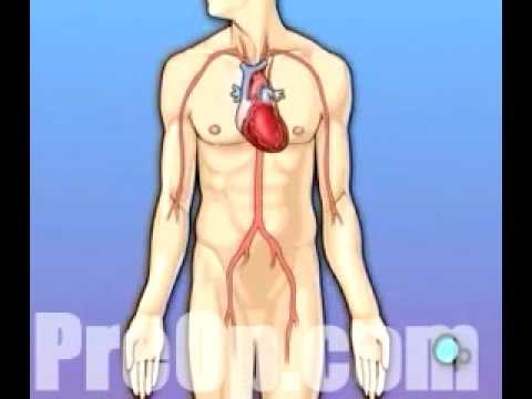 Thumbnail for PreOp® Patient Education Heart Surgery Coronary Artery Bypass Graft (CABG by The D.O.C., R.E.M., Head, Y&T, Sting