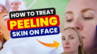 HOW TO TREAT PEELING SKIN ON FACE