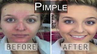 Home Remedies to Reduce Pimple Redness - How To Remove Pimples Overnight