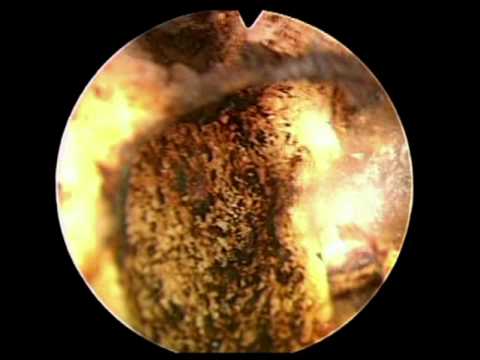La scienza del cancro alla prostata Candele e analoghi prostatilen