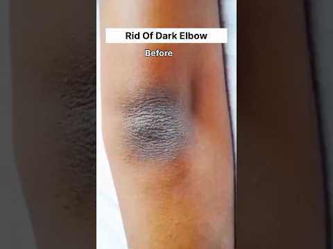 Elbow Cleaning Tips || Get Rid Of Dark Elbow & Knees || Clean Dark Skin #dark #elbow #knee #shorts