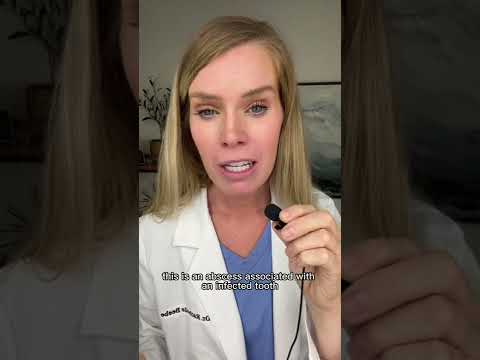 Swollen cheek and what it means. #swelling #swollen #infection #dentist