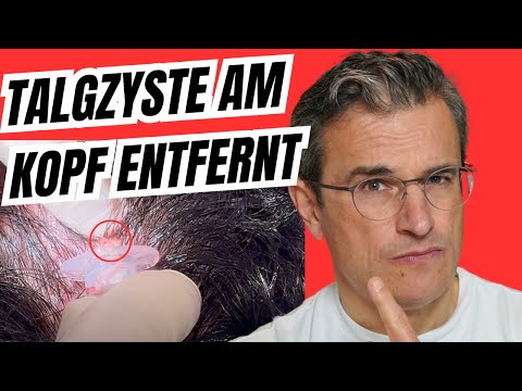 💥 Schmerzlose Zysten-OP am Kopf! So läuft das DANA-Verfahren ab
