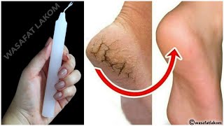In Just one night - Get Rid of CRACKED HEELS Permanently, Magical Cracked Heels Home Remedy