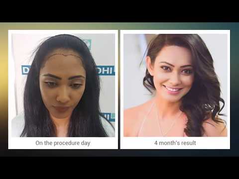 Female Hair Transplant - Miss Srilanka Yureni Noshika’s Hair transplant result after DHI