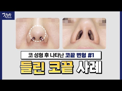 코 성형 후 생긴 코끝 변형..?!｜#들린코 #들창코｜원인부터 해결 방법까지!