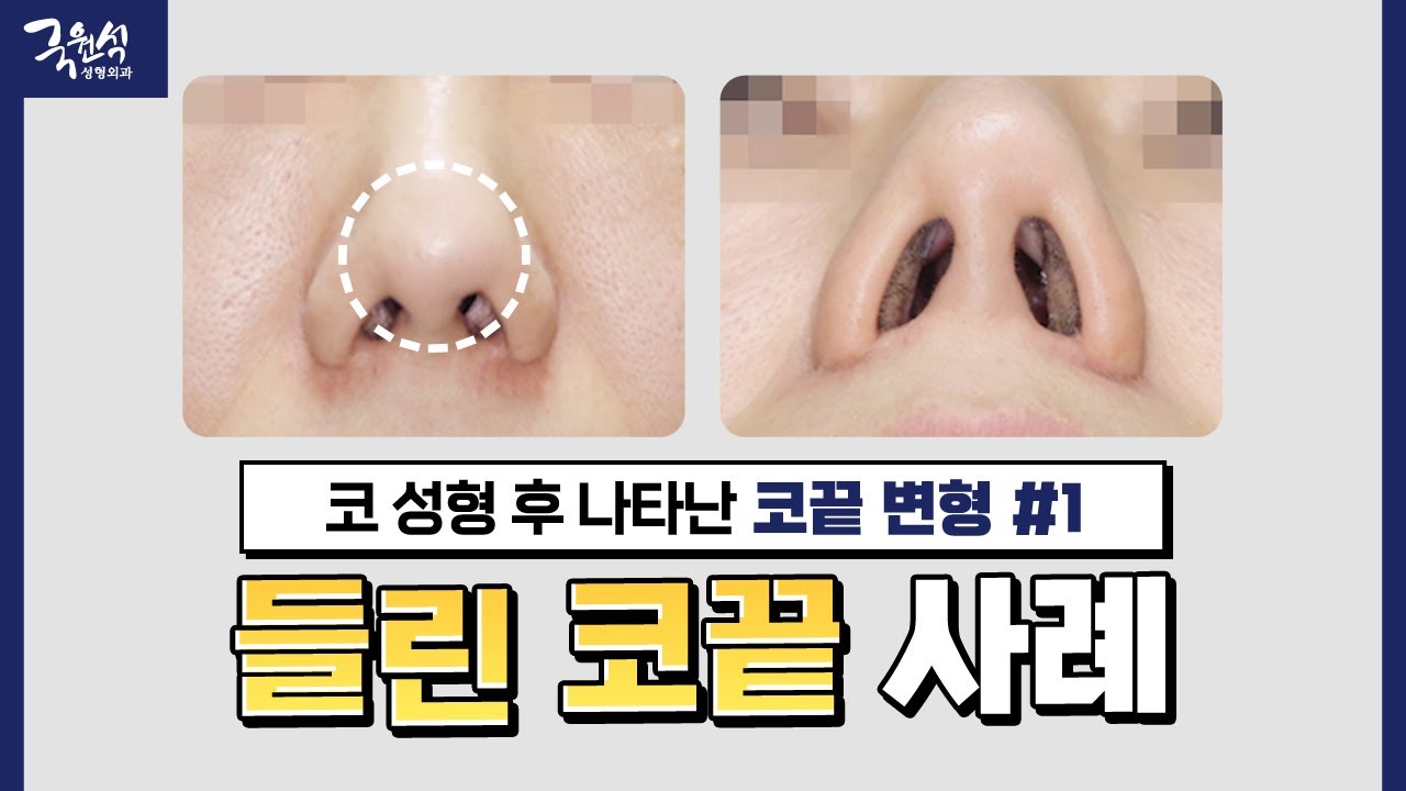 코 성형 후 생긴 코끝 변형..?!｜#들린코 #들창코｜원인부터 해결 방법까지! 썸네일