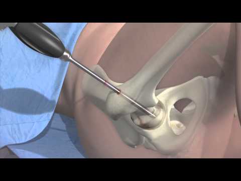 Stem Cells Get Hip - Mayo Clinic