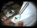Minimally Invasive Aortic Valve Replacement With Mini Upper Sternotomy