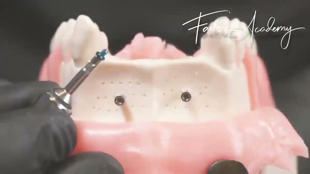 Ridge Augmentation Protocol for Implant Placement on a model