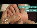 Callus removal from feet + small seed corn Callus removal from feet + small seed corn