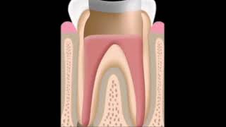 ¿Qué es una caries