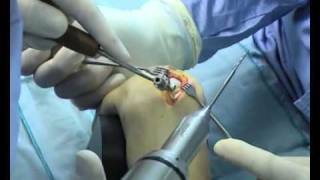 HBS | Headless Bone Screw | Part 2