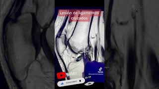 Resonancia de ligamentos cruzados