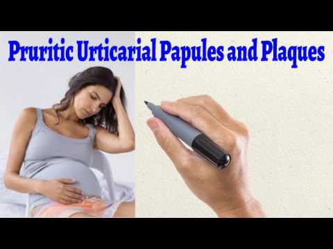 Pruritic Urticarial Papules - Pruritic Urticarial Papules and Plaques of Pregnancy Video